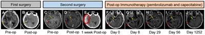 Unexpected curative effect of PD-1 inhibitor in gastric cancer with brain metastasis: A case report
